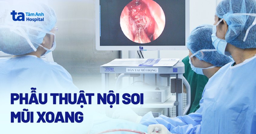 nội soi mũi xoang