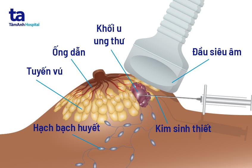 Các phương pháp sinh thiết lõi kim