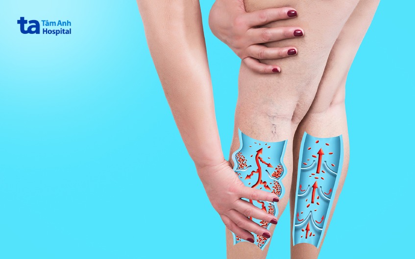 siêu âm duplex chẩn đoán bệnh gì