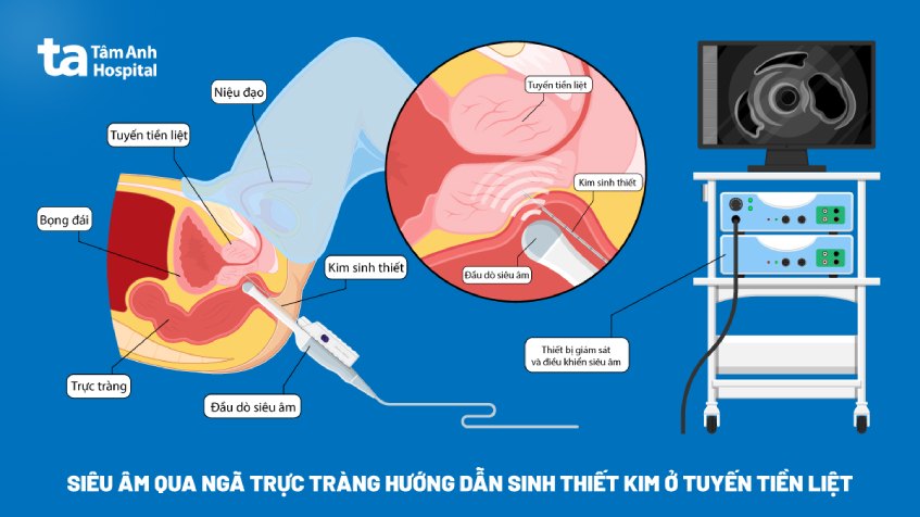 siêu âm qua ngã trực tràng