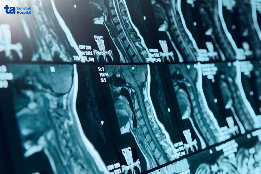 Siêu âm tuyến giáp là phương pháp phổ biến