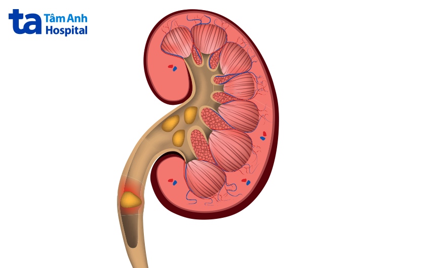 bệnh sỏi niệu quản