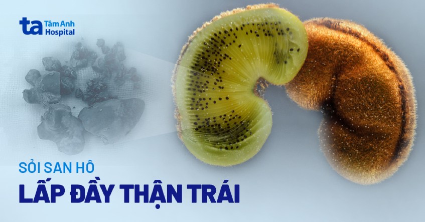 sỏi san hô lấp đầy thận trái