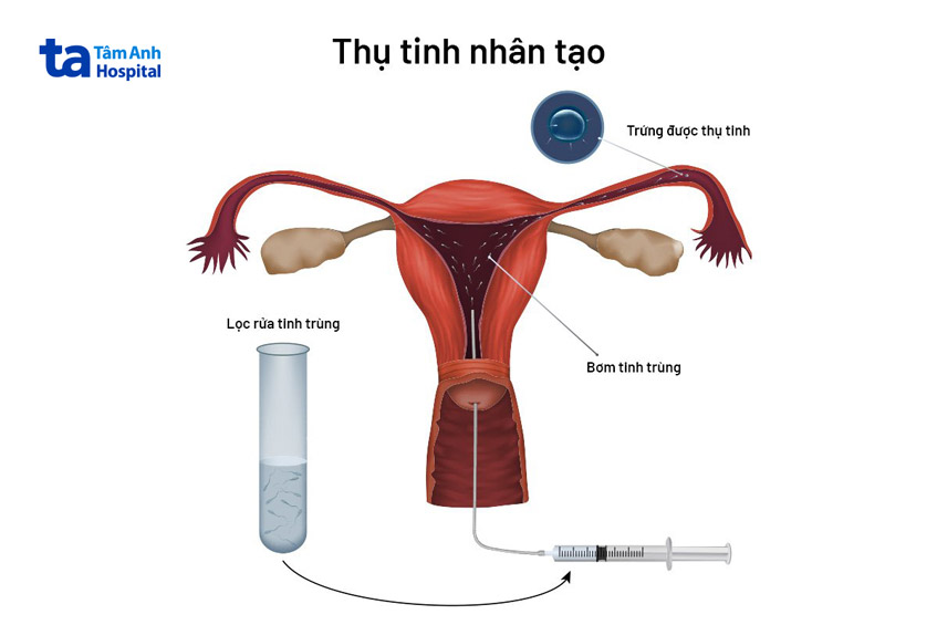 thụ tinh nhân tạo iui
