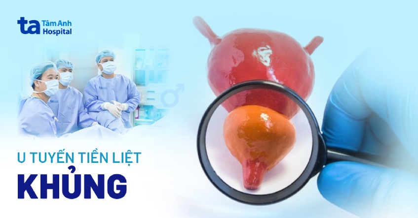 Tiểu mỗi giờ do tuyến tiền liệt to gấp 4 lần