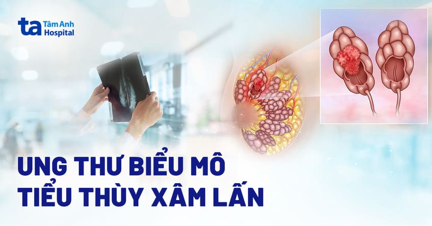 Ung thư biểu mô tiểu thùy xâm lấn