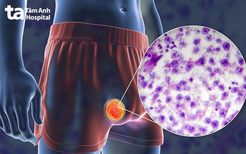 ung thư tinh hoàn