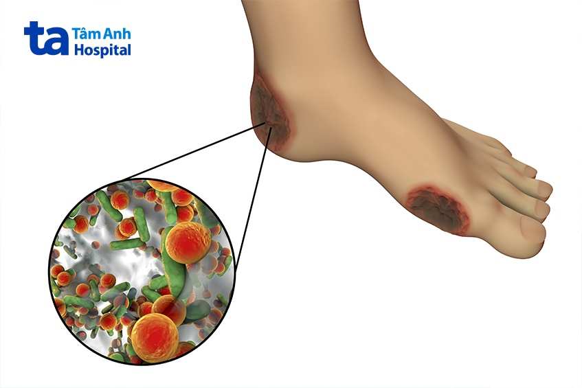 Vết thương ở chân người bệnh tiểu đường