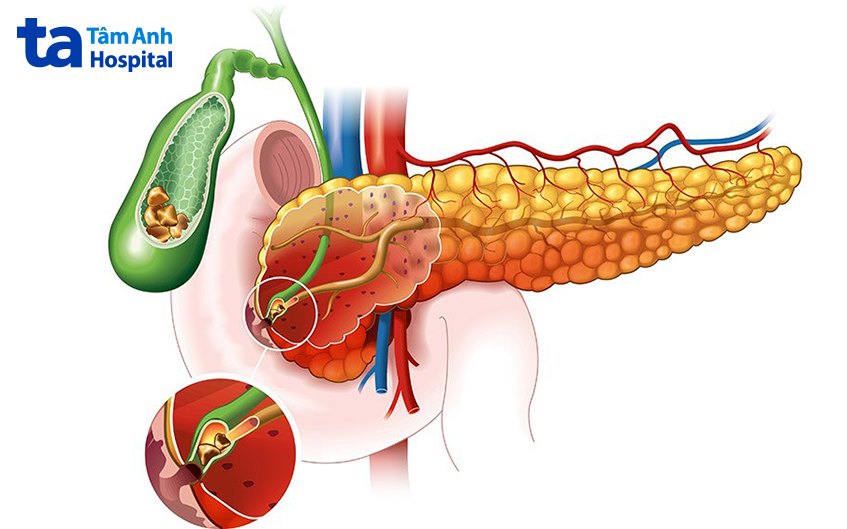 vị trí đau sỏi mật