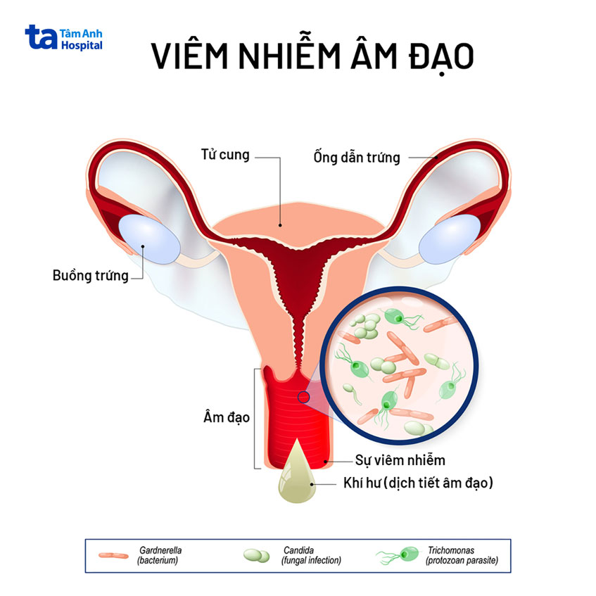 viêm nhiễm âm đạo