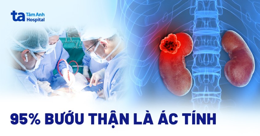 95% bướu thận là ác tính