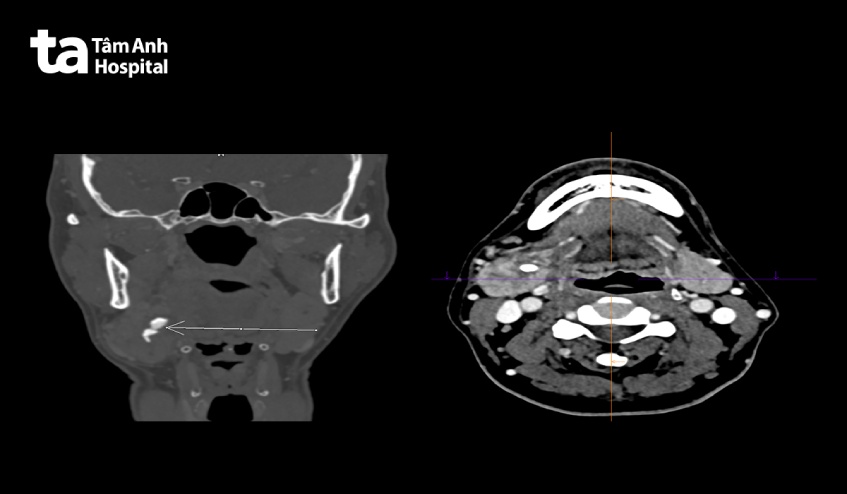 CT-scan sỏi dưới hàm