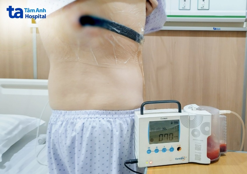 Anh C. được đặt máy hút áp lực âm