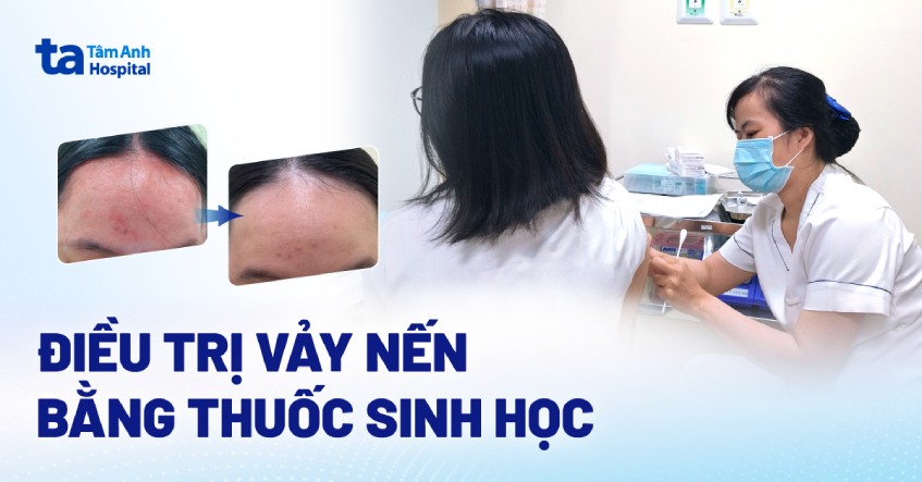điều trị vảy nến tại bvđkta