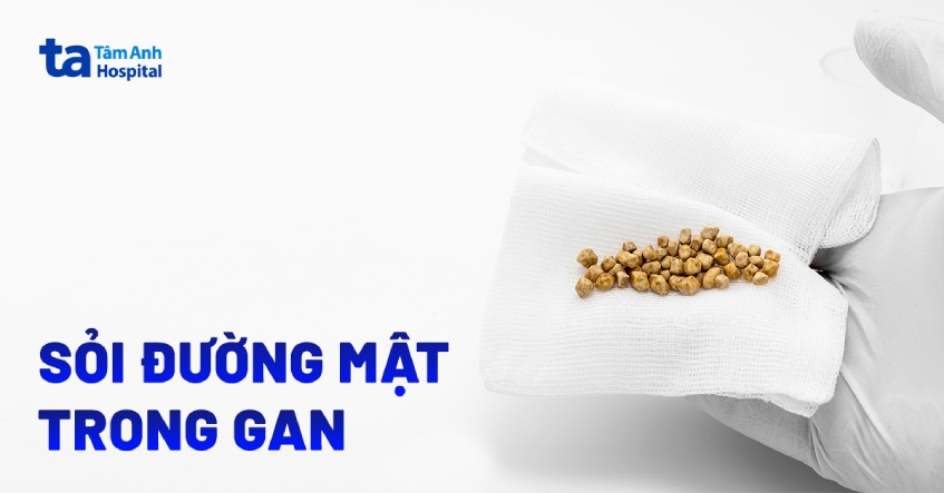 bệnh sỏi đường mật trong gan