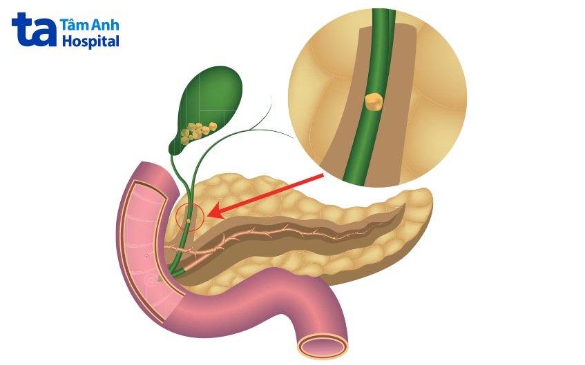 bệnh sỏi túi mật