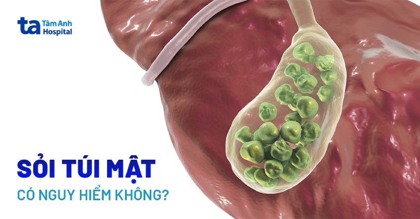 bị sỏi túi mật có nguy hiểm không