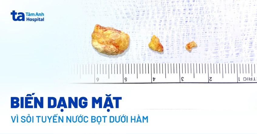 Biến dạng mặt vì một khối kỳ lạ dưới hàm