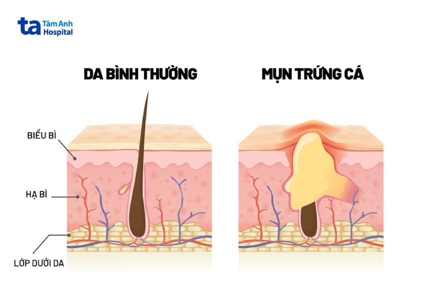 các dạng mụn trứng cá nặng