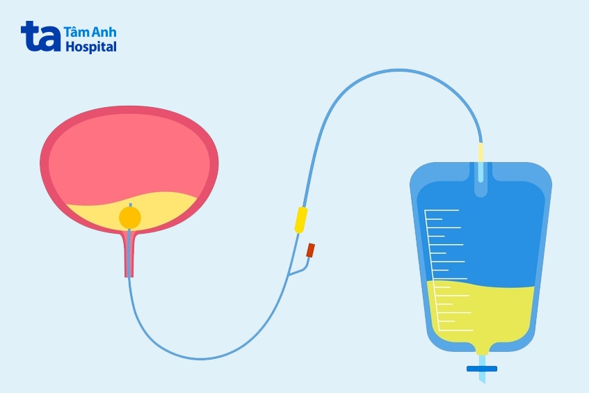 các loại ống thông tiểu