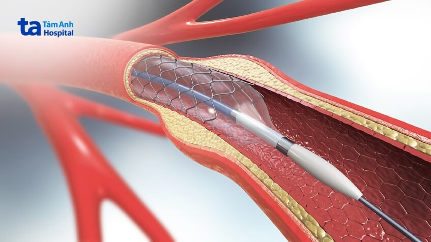 cách điều trị đột quỵ thiếu máu cục bộ