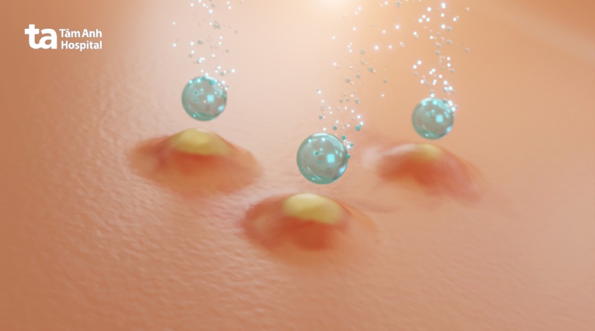 chăm sóc da sau điều trị mụn trứng cá nặng