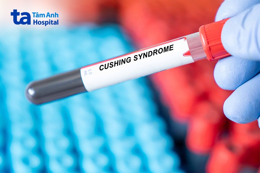 chẩn đoán chính xác hội chứng Cushing