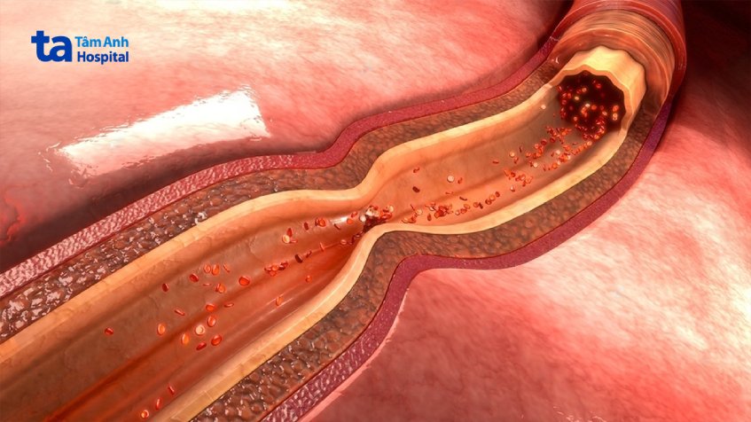 Có nhiều yếu tố dẫn đến bệnh co thắt động mạch vành