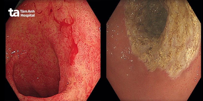 công nghệ Argon Plasma