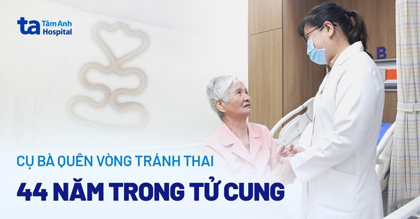 Cụ bà quên vòng tránh thai 44 năm 