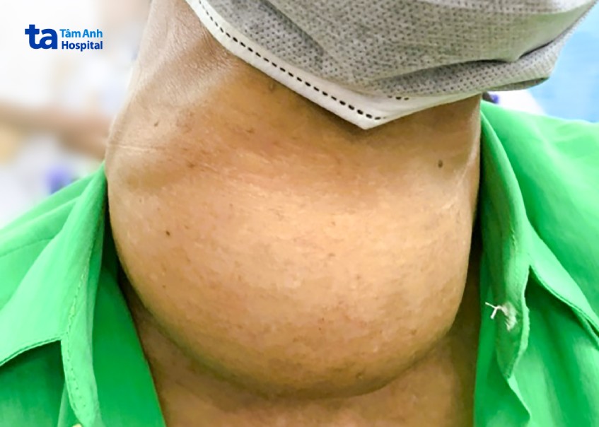 dấu hiệu bất thường ở cổ cần đi khám sớm