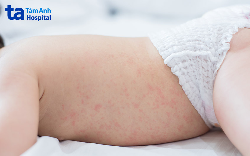dấu hiệu khi trẻ mắc bệnh