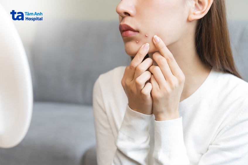 dấu hiệu mụn trứng cá mủ