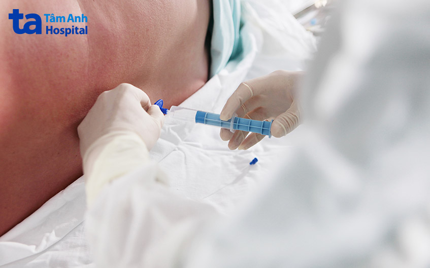 điều trị thoát vị không phẫu thuật