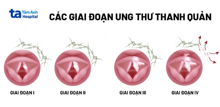 giai đoạn 2 trong ung thư thanh quản