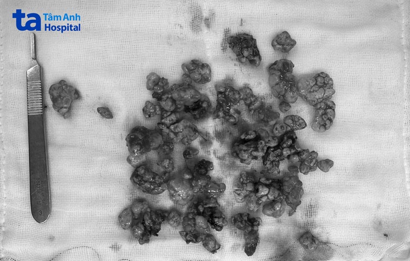 hạt u sụn ở khớp