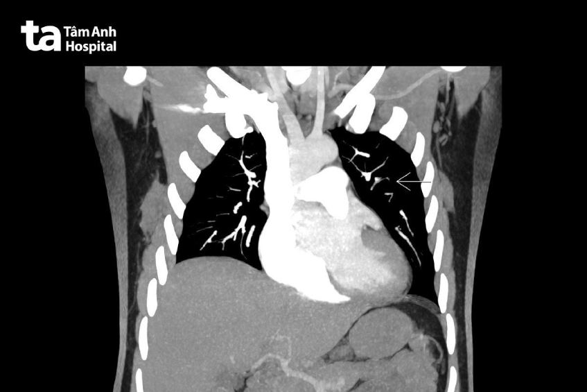 Hình ảnh CT cản quang cho thấy huyết khối động mạch phổi