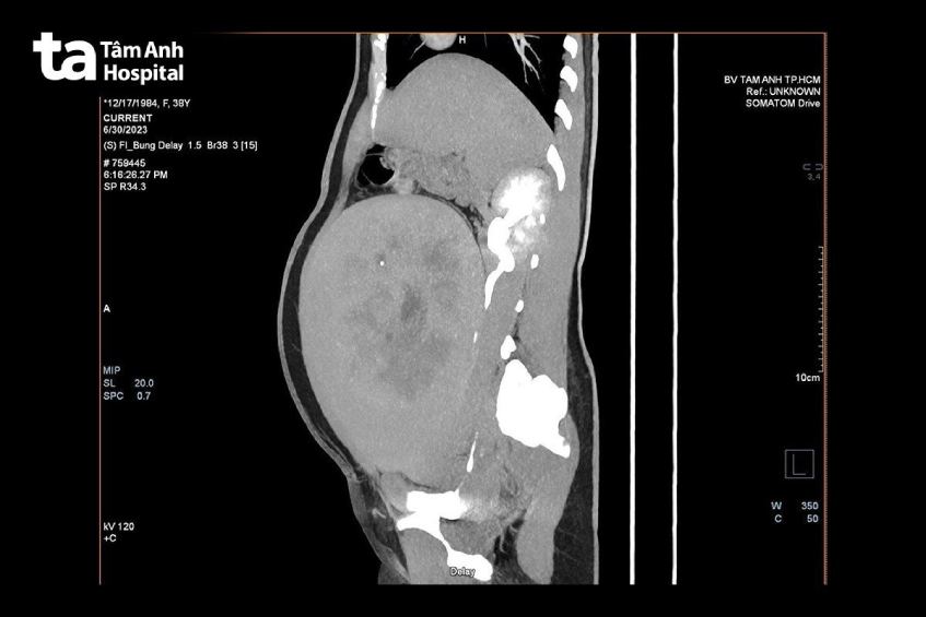 Hình ảnh CT cho thấy u xơ tử cung chèn ép gây giãn niệu quản và ứ nước thận phải