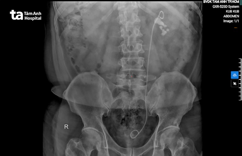 hình ảnh sỏi thận trên xquang