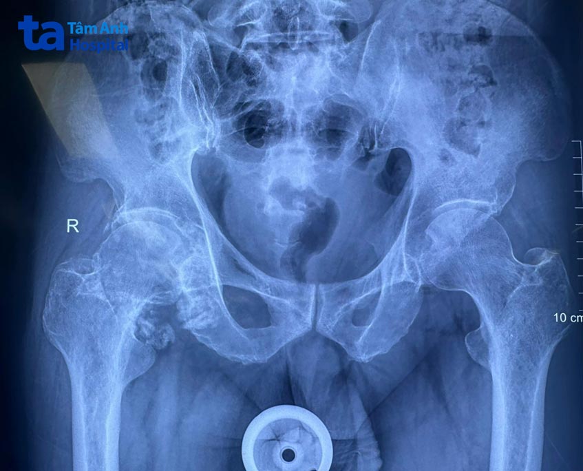 hình ảnh x quang khớp háng