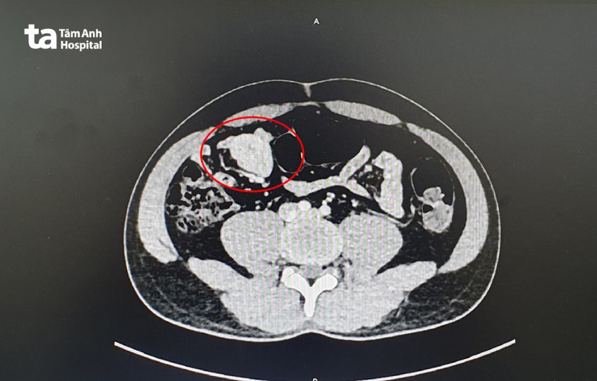 Khối u mạc treo ruột non