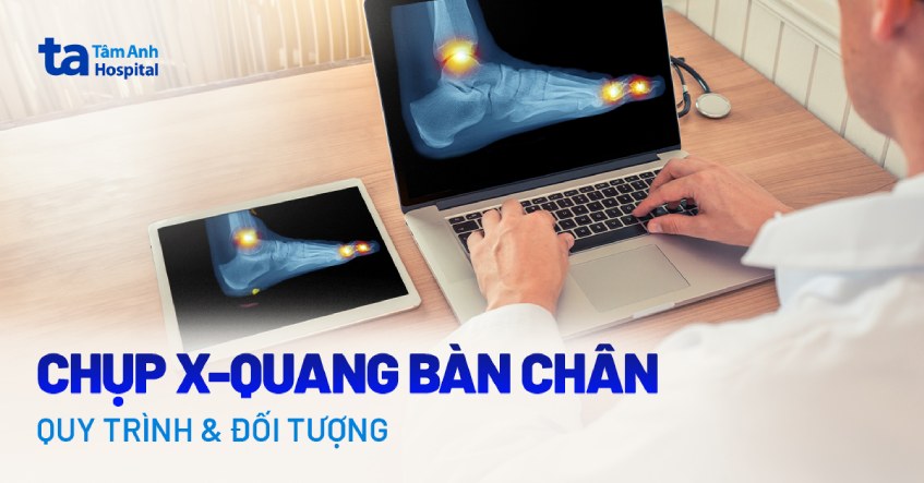 chụp x quang bàn chân
