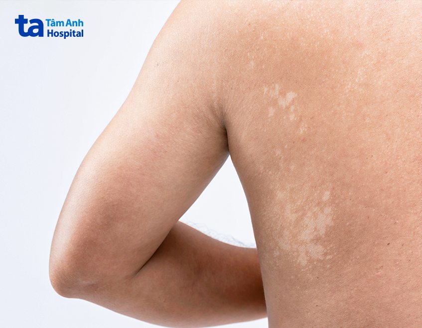 lang ben có tái phát không