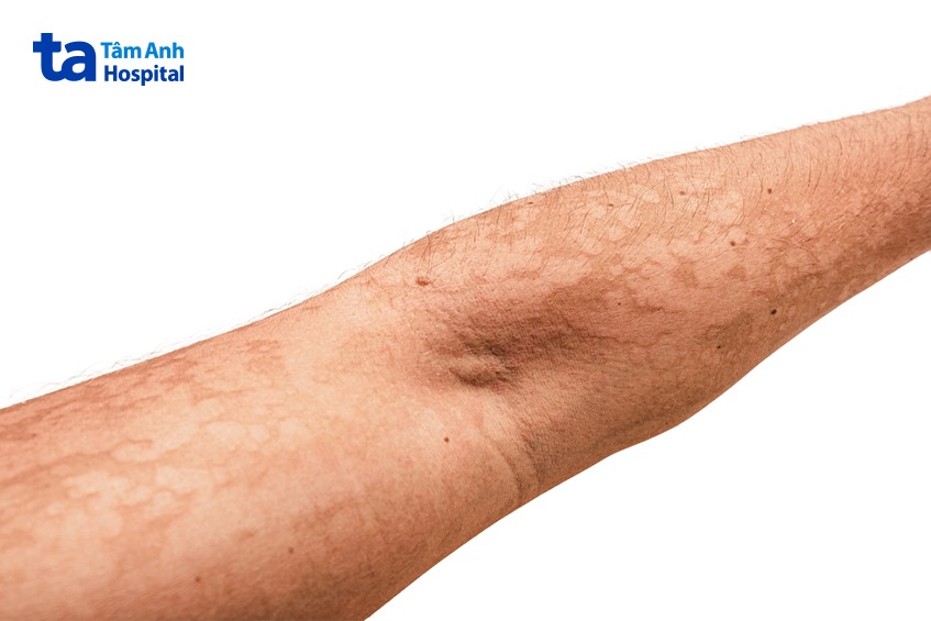 Lang ben đỏ rải rác trên cánh tay