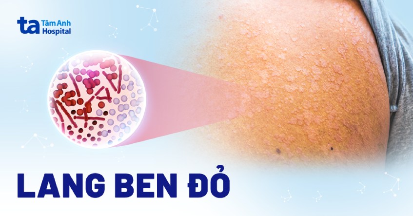 Lang ben đỏ: Nguyên nhân, dấu hiệu, chẩn đoán, cách chữa trị