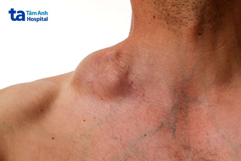 lymphoma hodgkin