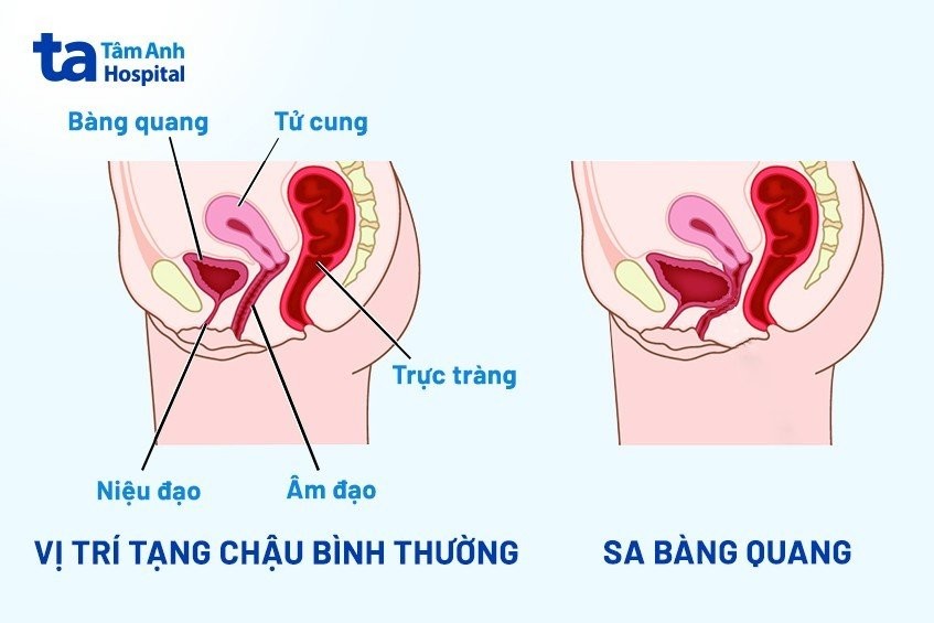 Mô phỏng các loại sa tạng chậu