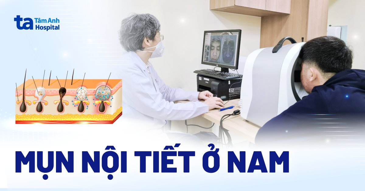 Mụn nội tiết ở nam