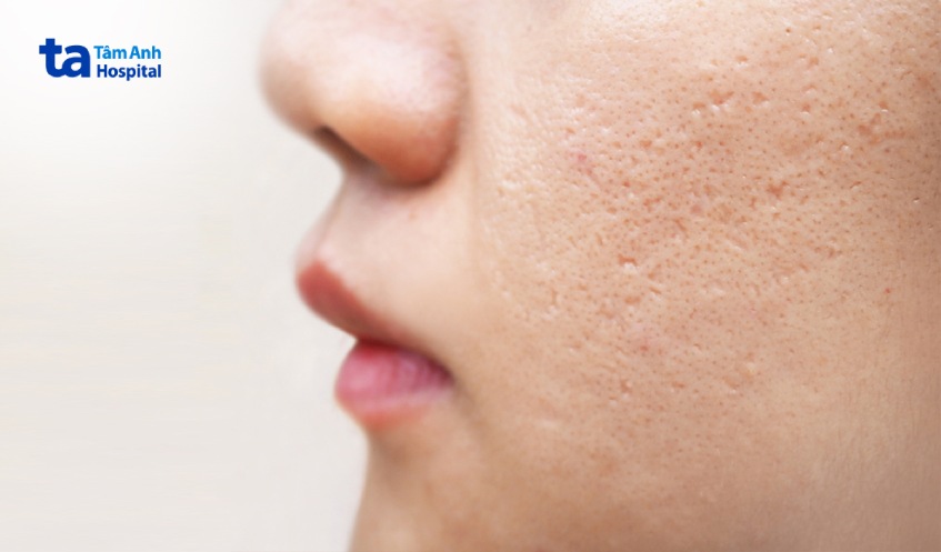 mụn trứng cá nặng có để lại sẹo không