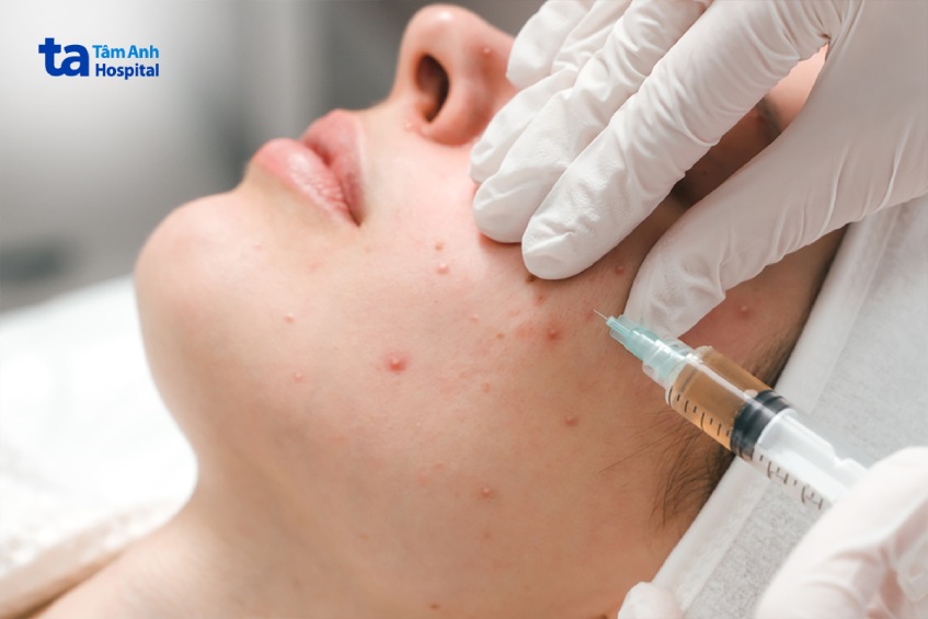 mụn trứng cá nặng điều trị